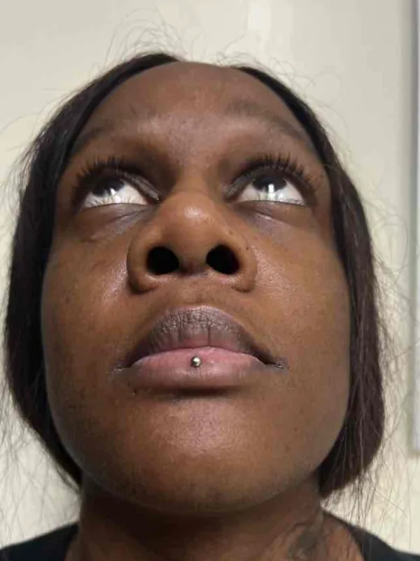 Before alar base reduction with rhinoplasty