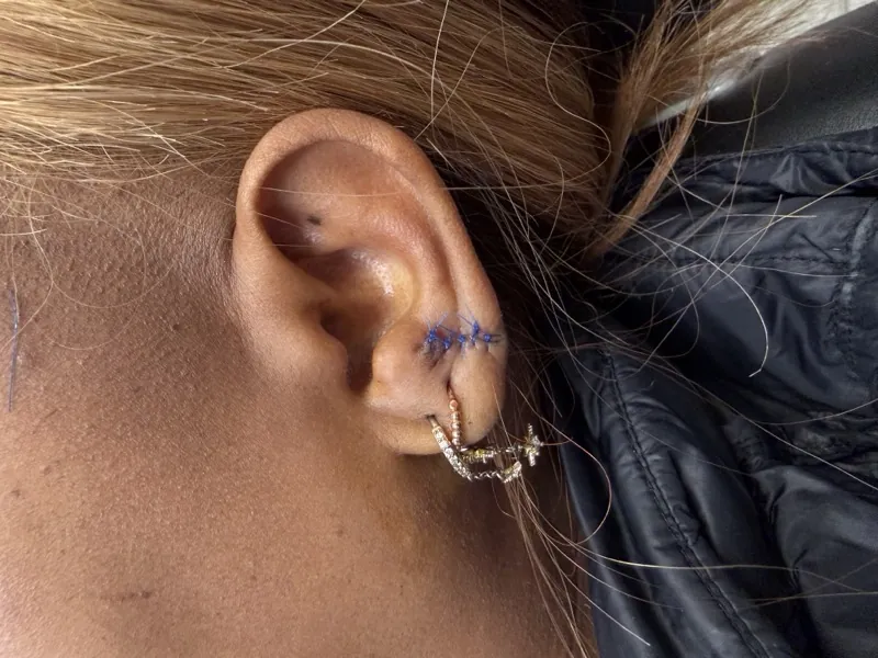 After keloid excision treatment