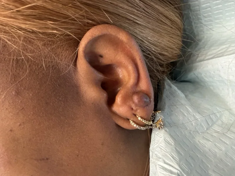 Before keloid excision treatment