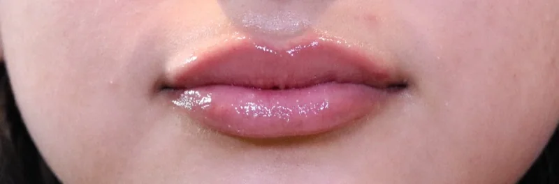 After lip filler treatment