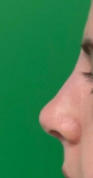 3 months after primary rhinoplasty profile view