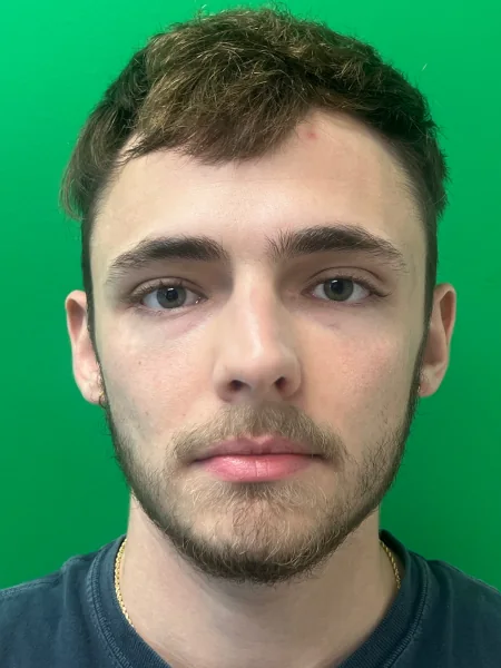 Before rhinoplasty front view