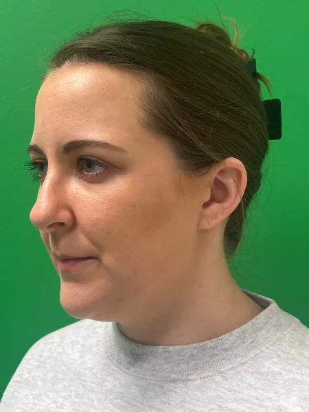 Before rhinoplasty oblique view