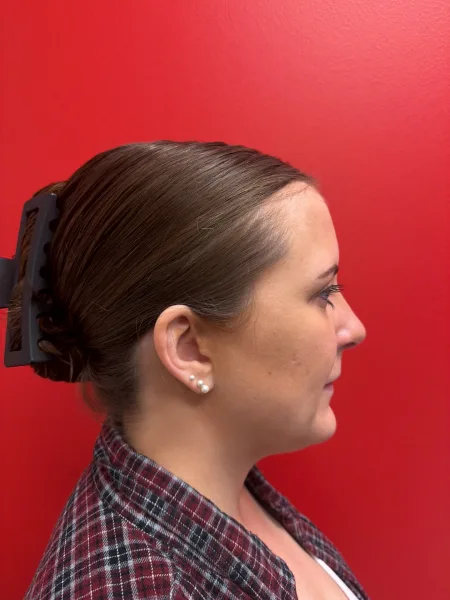 3 months after rhinoplasty right profile view