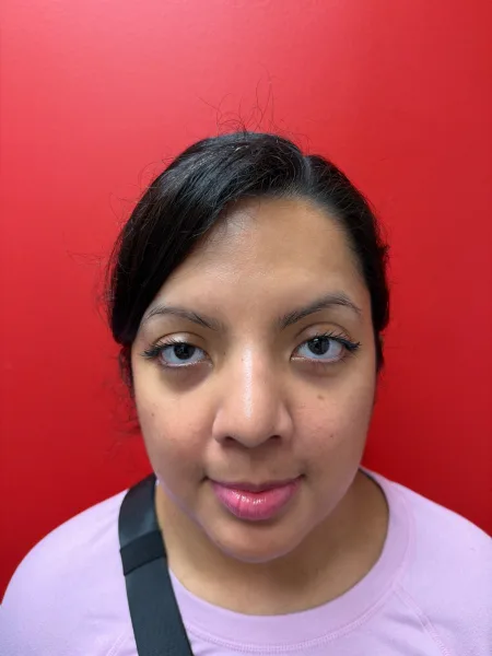 View 1 3 months after rhinoplasty