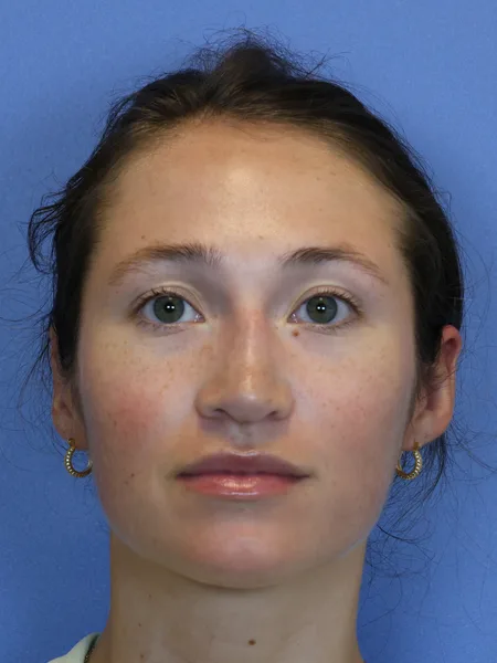 2 months after rhinoplasty front view