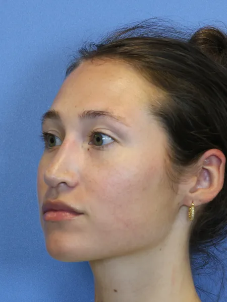 2 months after rhinoplasty left oblique