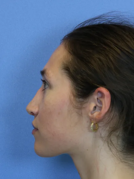 2 months after rhinoplasty left profile
