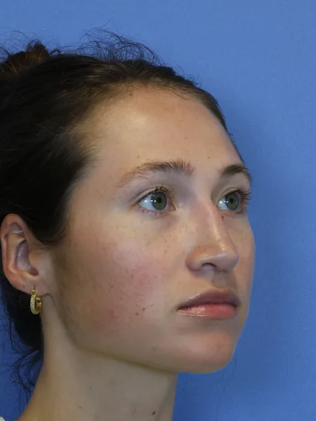 2 months after rhinoplasty right oblique