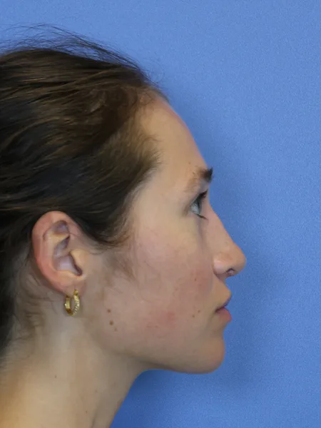 2 months after rhinoplasty right profile