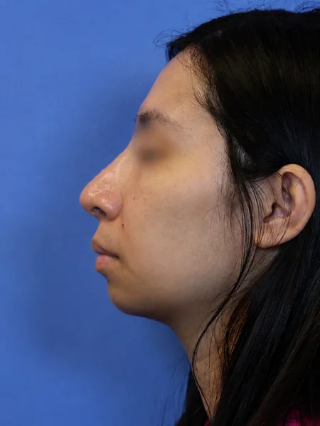 3 months after rhinoplasty left profile view